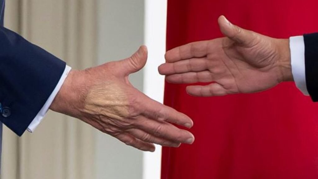 Donald Trump diagnosed with Chronic Venous insufficiency say White House